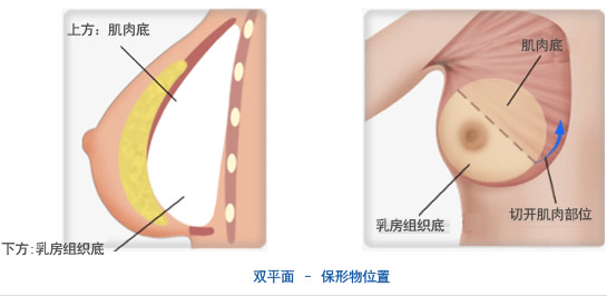 原辰整形外科隆胸的手术方法及隆胸假体的种