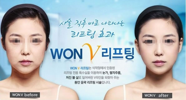 V 提升手术案例